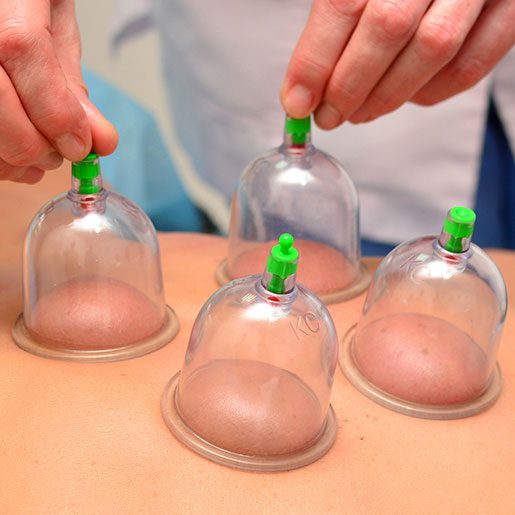 What Does Cupping Do For You?
